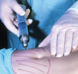 Липосакция