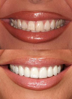 Виниры на зубы